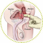 therapeia-prostati