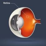 Ακτινοθεραπεία-ελπίδα για την εκφύλιση ωχράς κηλίδας