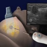 «Παγωμένη» μέθοδος εξολοθρεύει τον καρκίνο του μαστού