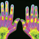 «Φρένο» στη ρευματοειδή αρθρίτιδα