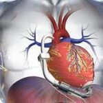 Μέχρι και 30% αναγεννούν το μυοκάρδιο οι κυτταρικές θεραπείες μετά το έμφραγμα