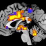 Οι μαγνητικές τομογραφίες «μετρούν» τον πόνο