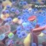 Το ruxolitinib βελτίωσε τη συνολική επιβίωση σε ασθενείς με μυελοΐνωση