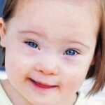 Ακριβέστερο τεστ για το σύνδρομο Down