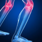 osteoporosi